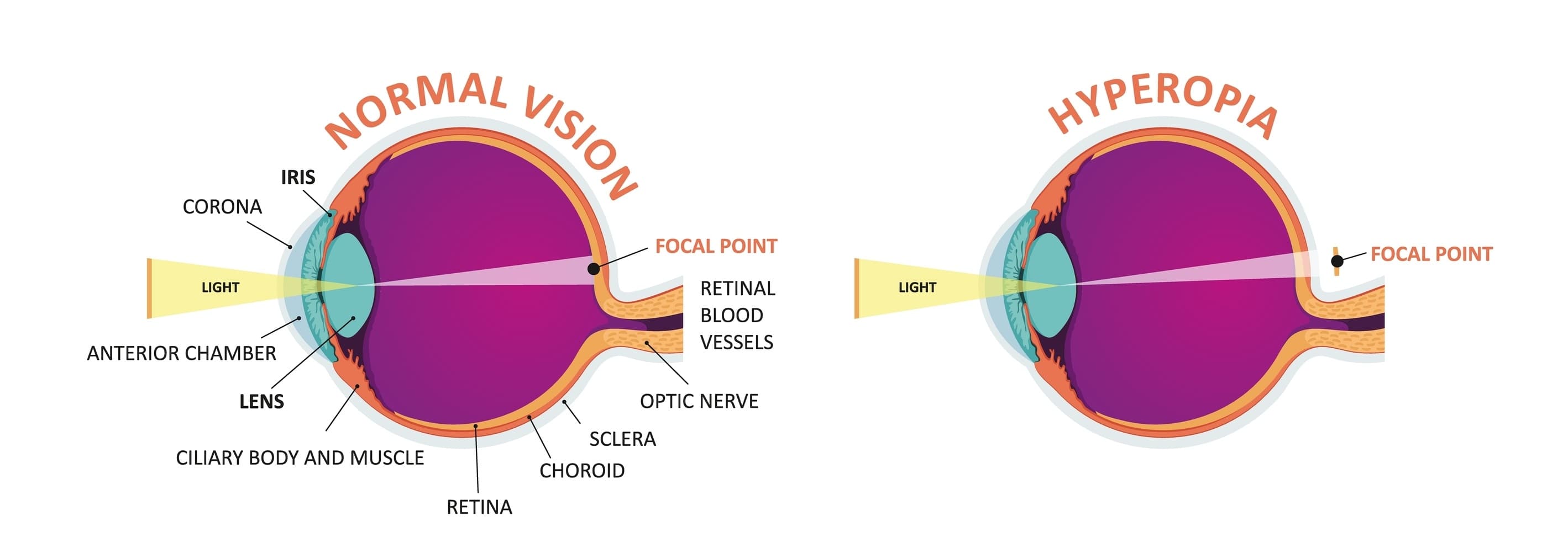LASIK for Farsightedness & Hyperopia in Chicago Kraff Eye Institute